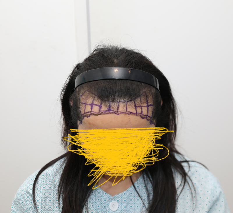 뉴헤어 모발이식 1년후 경과
