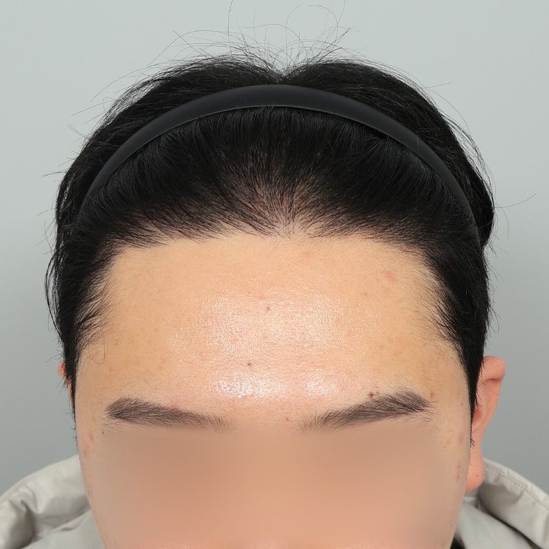 수술 후 368일차 (1).jpg