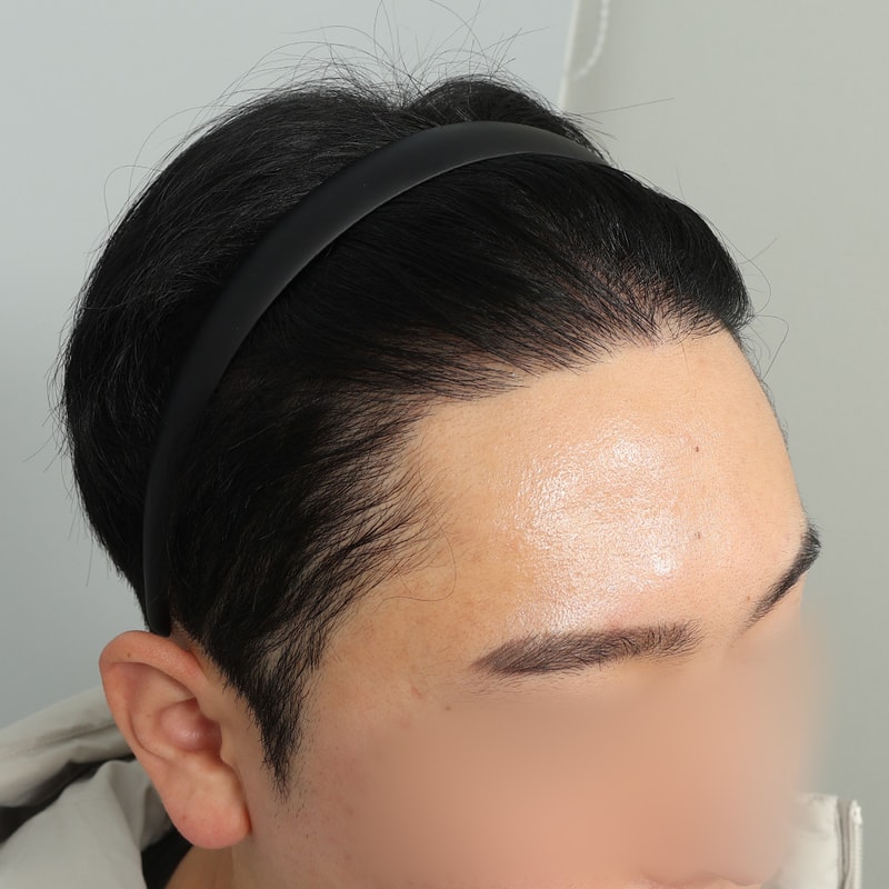 수술 후 368일차 (2).jpg