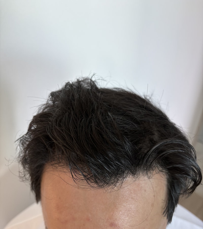 Surgery in 7000-mo Dana Plastic Surgery for non-cutaneous mass hair transplantation.