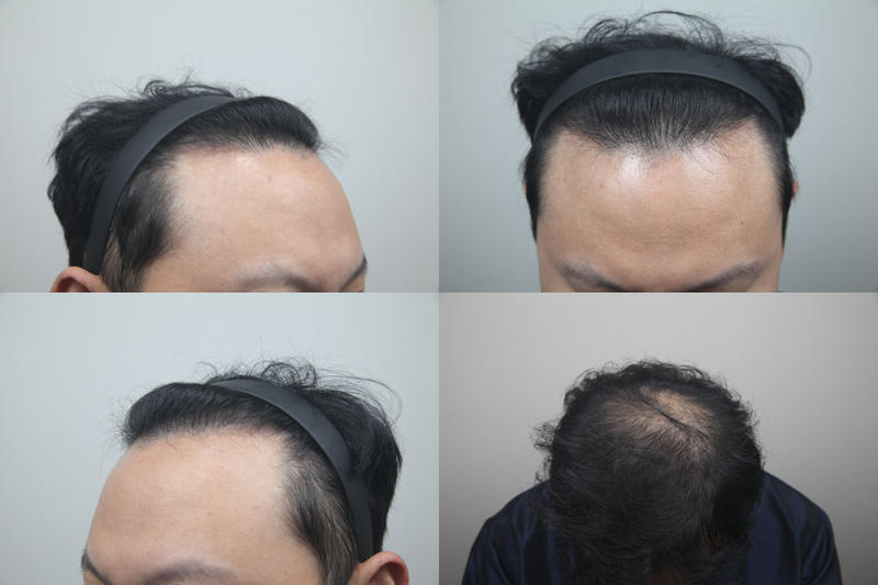 모발이식 전.png