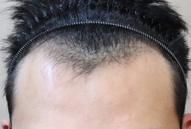 Hair Transplant Leave a picture of the 2nd week.