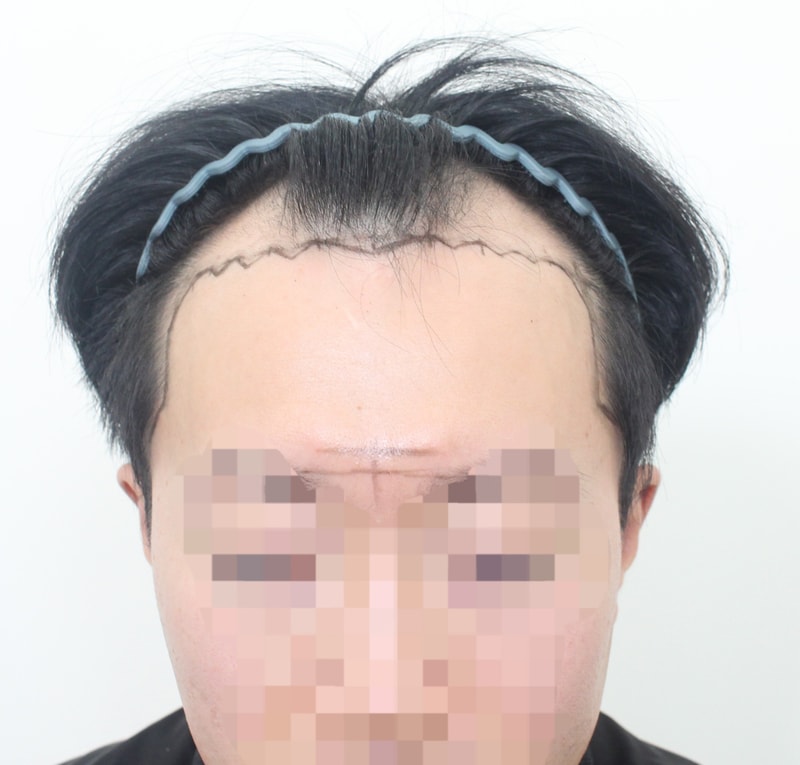 이식 전(정면).jpg