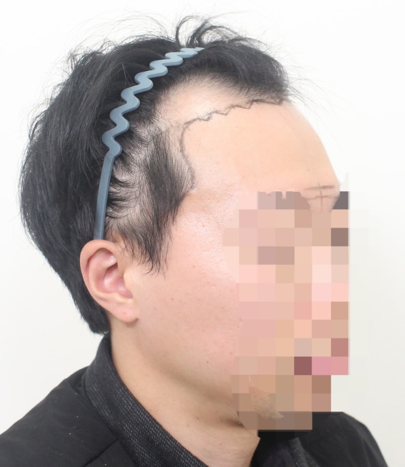 이식 전(측면).jpg