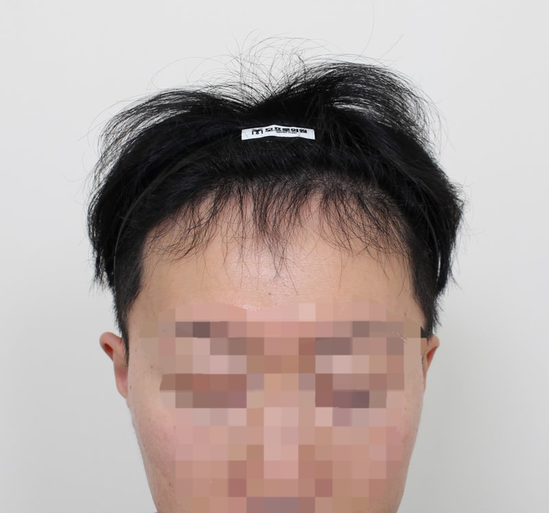 6개월차(정면).jpg