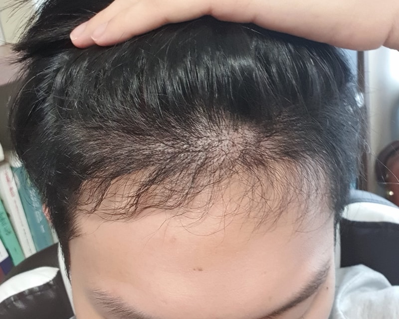 5년 전 절개 후 인천 맘모스에서 비절개 모발이식 재수술 받았습니다