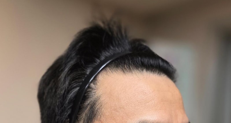 모발이식 1년 지난 후기 (루트테마)