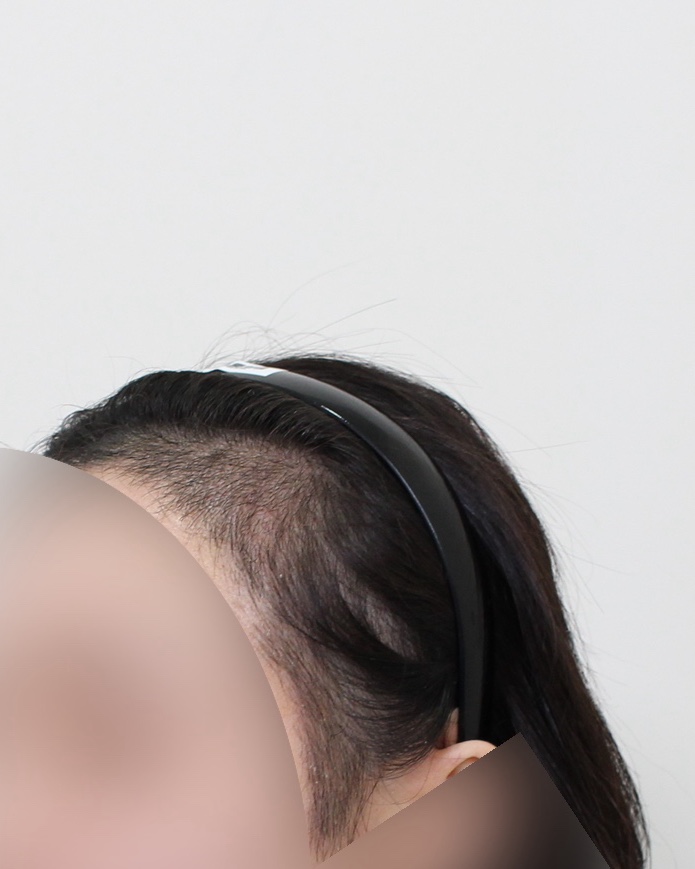 ★모프로의원★문건학 대표원장님★지인소개★헤어라인+구레나룻이식 9일