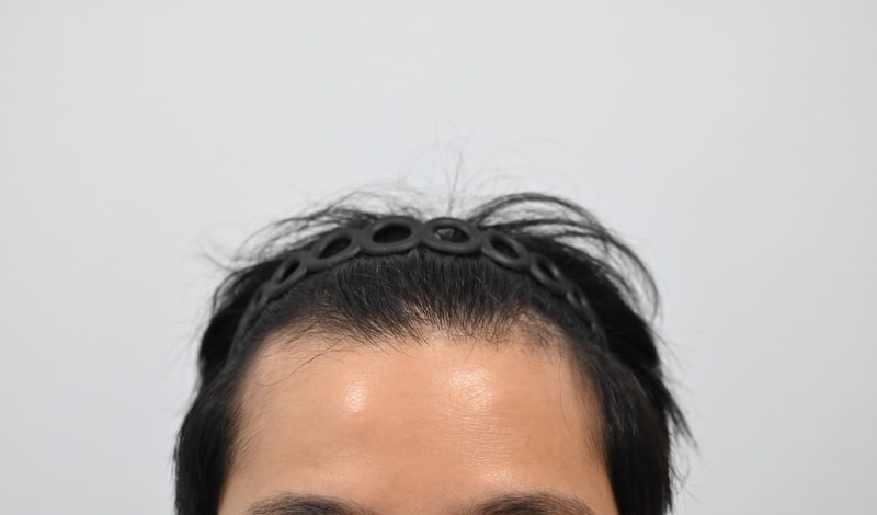 모엠의원 전지훈 원장님 3200모 10일차 후기