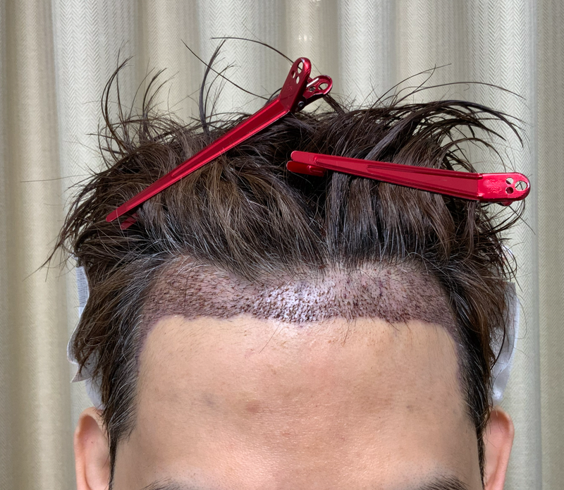 수술후1일차찐1.PNG