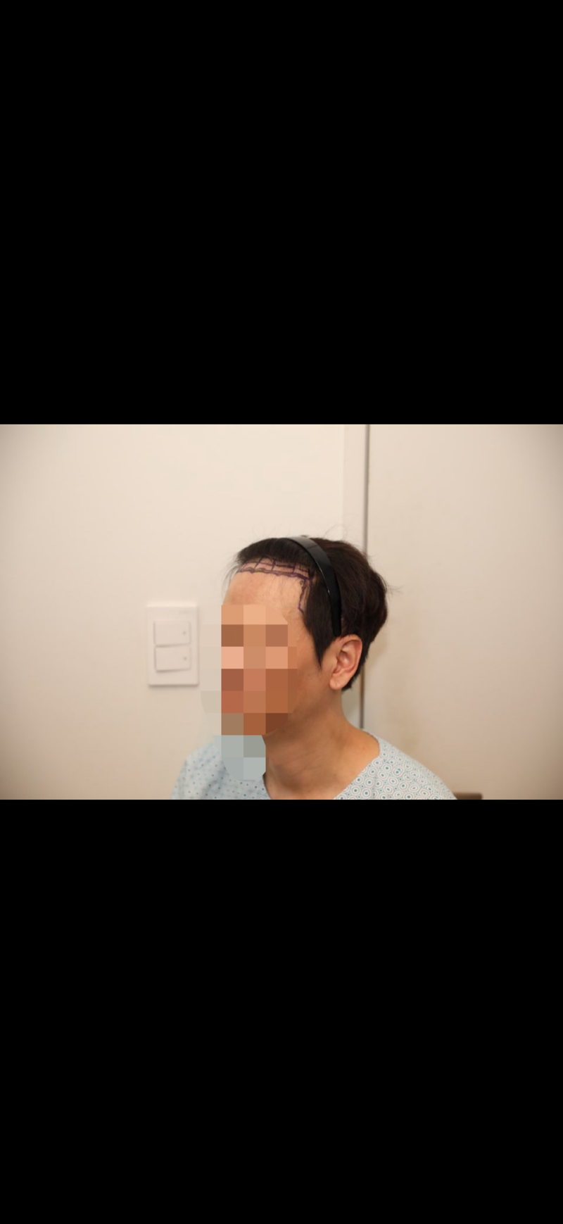 This is the review of the 12th month of Hair Transplant. a NEWHAiR hospital