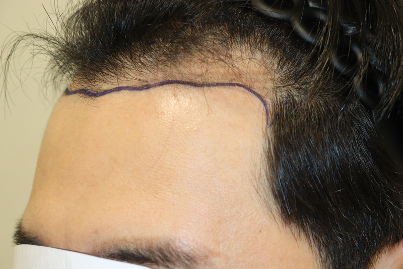 대구 헤어로의원 비절개 노컷 2700모 9개월 경과 후기