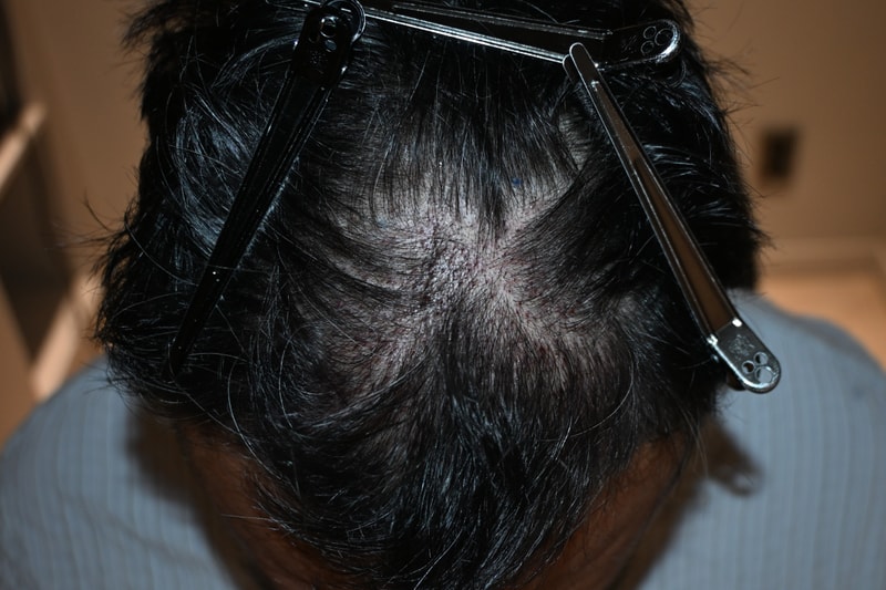수술 1일차 (정수리).jpg