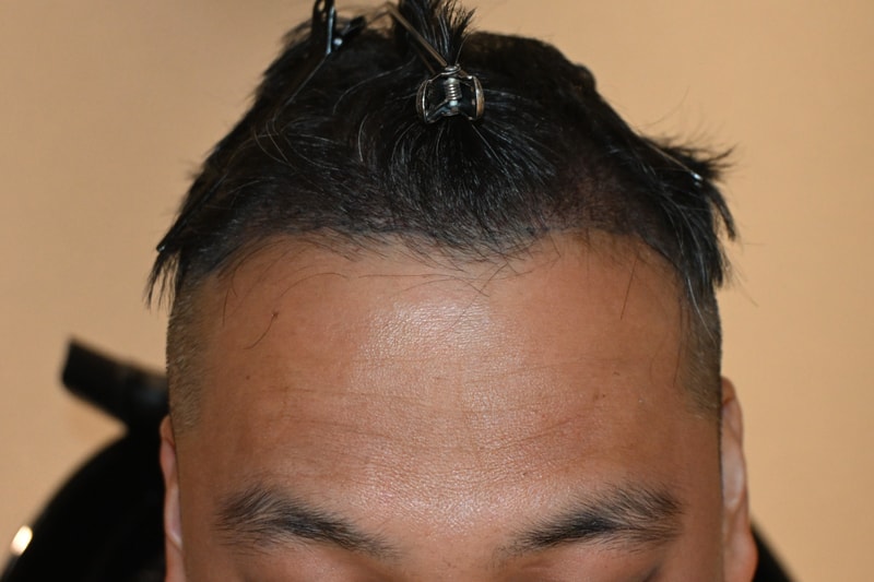 수술 1일차 (정면).jpg