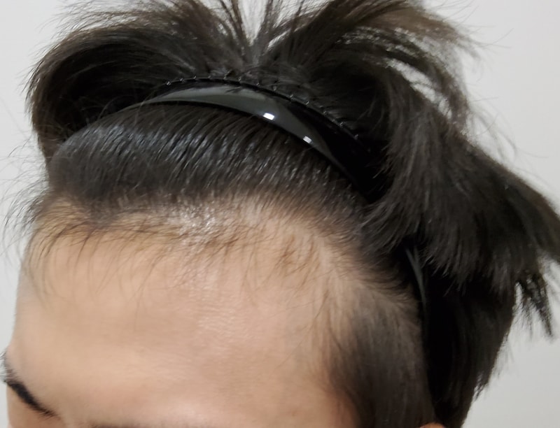 1. 수술전_2.jpg