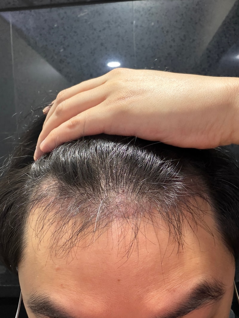 인천 마이모의원 이식 3개월차