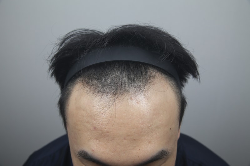 모나라에서 비절개 5226모 모발이식 했습니다!