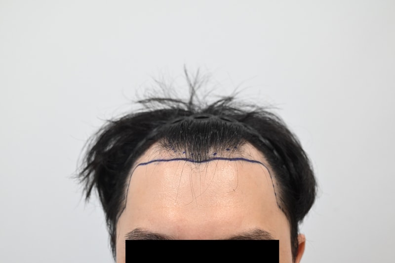 모엠의원 M자 후기 3769모