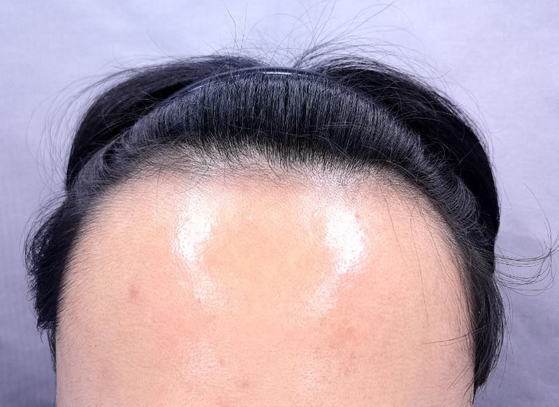 남자 헤어라인 비절개 모발이식수술 1년까지 기록