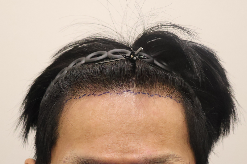 밀도 보강 느낌으로 헤어로의원 가서 1500모 비절개 모발이식 받았습니다.