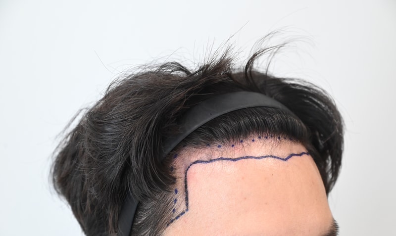 [모엠의원] 비절개 히든컷 2500모 후기 (1년 3개월 후)