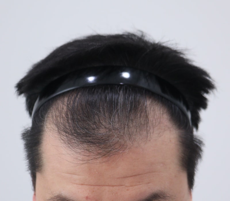1. 수술전_1.JPG