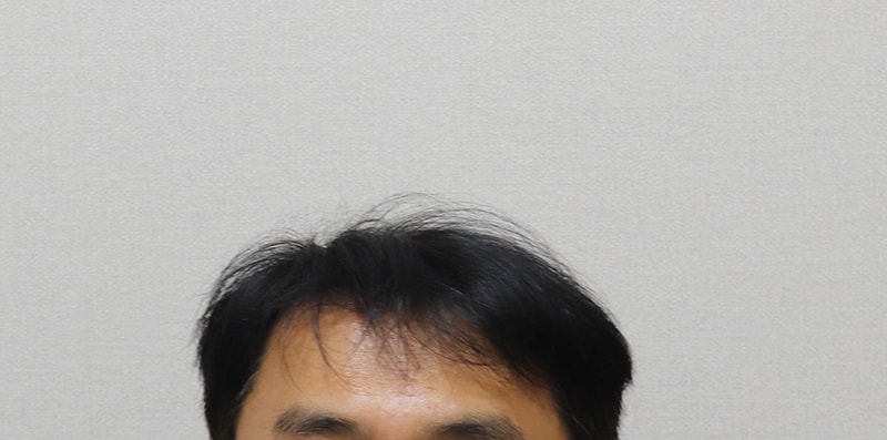 9. 수술전 헤어 스타일.JPG