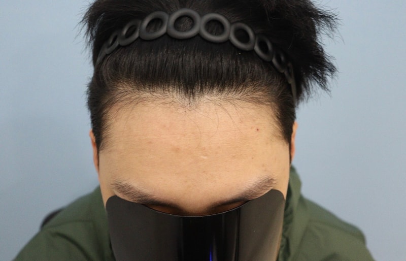 광주 압구정 모비앙 의원 모발이식 1년 경과 후기