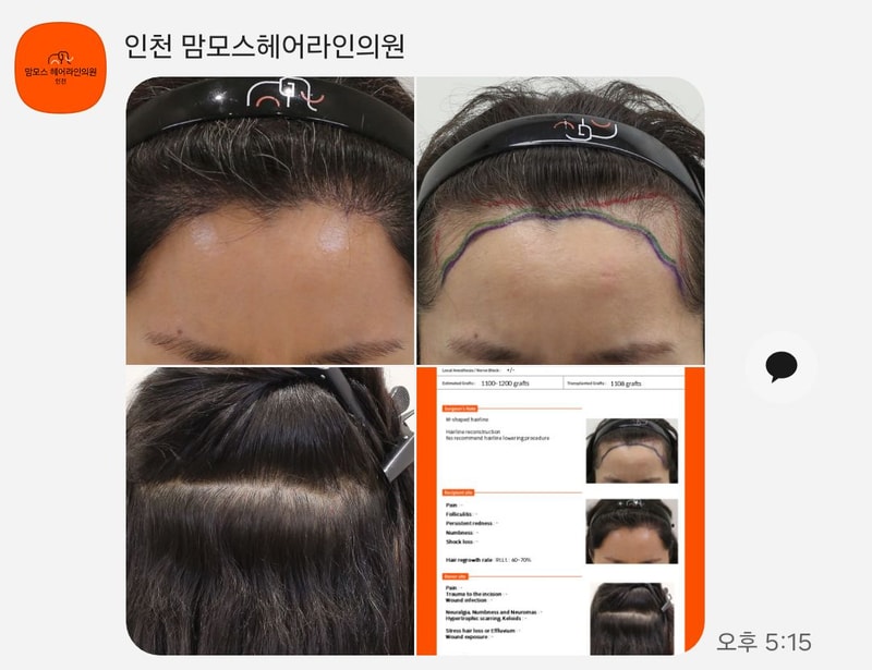 인천 맘모스헤어라인의원 모발이식6개월차후기입니다