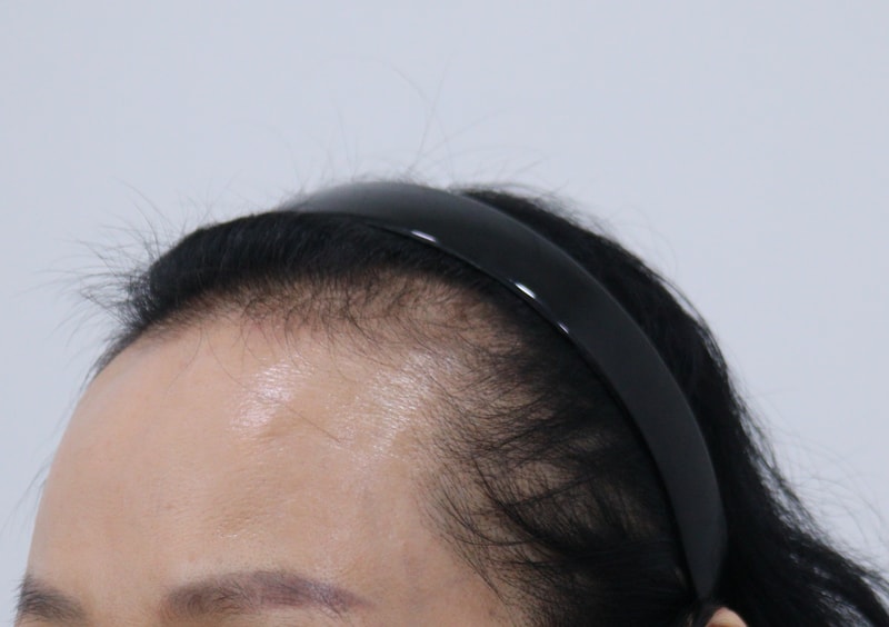 1. 수술전_2.JPG