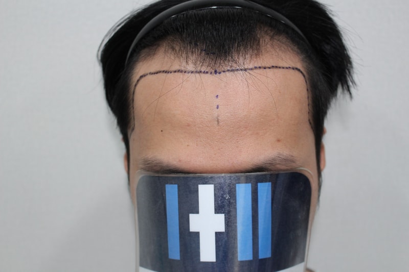 모더함의원, 비절개 모발이식 6개월 중간 경과
