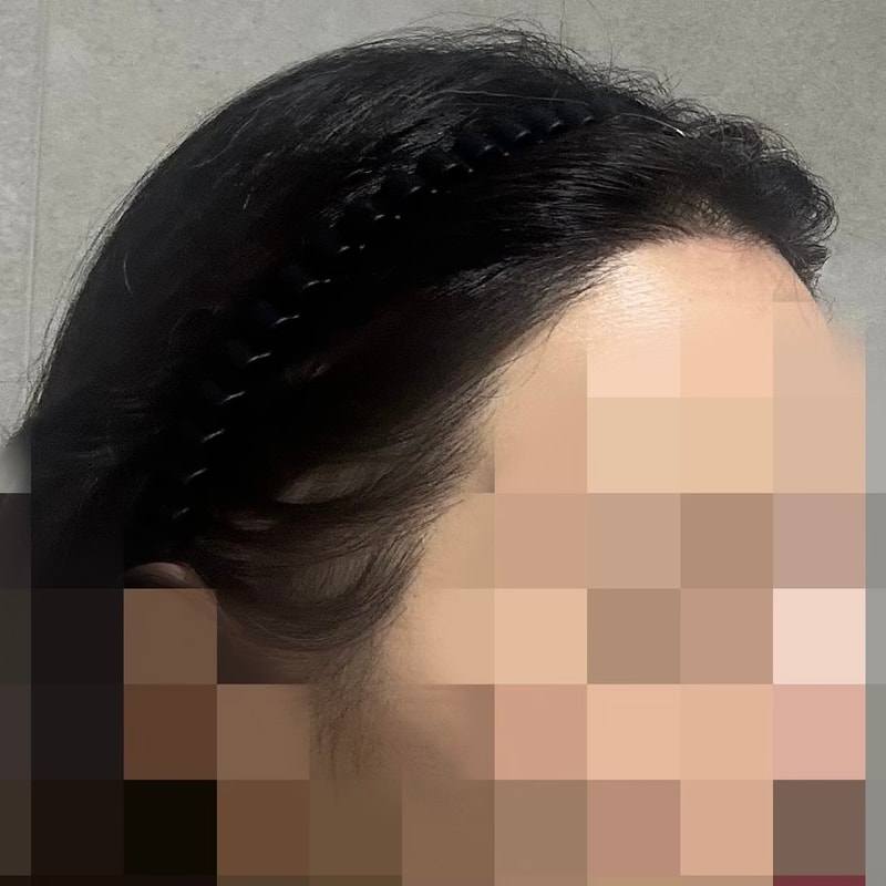 절개, 1800모낭, 12개월 차