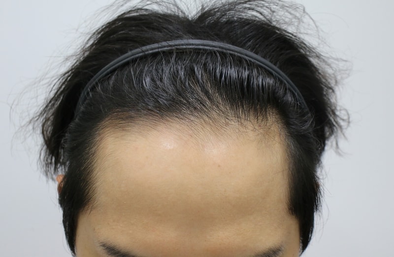 포헤어(민영기 원장님) 비절개슬릿 9개월차 후기