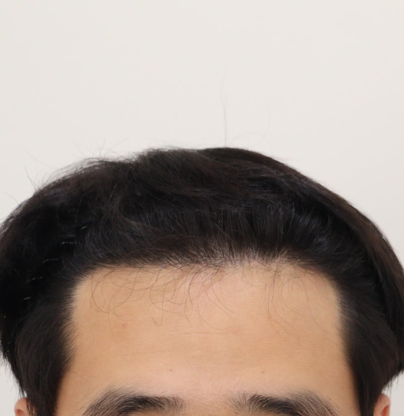 4. 수술후_9개월_1.JPG