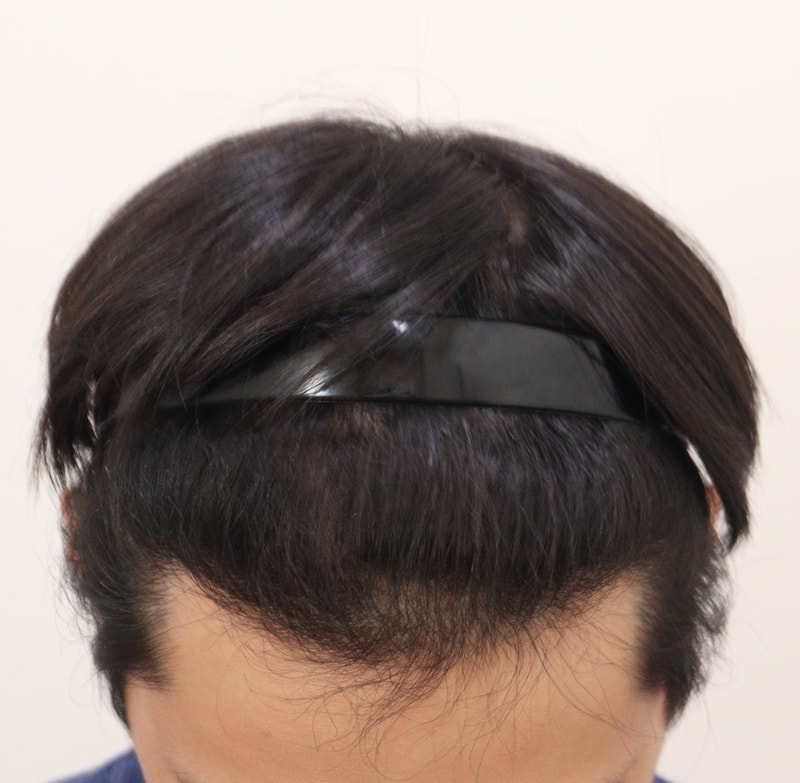 4. 수술후_9개월_2.JPG