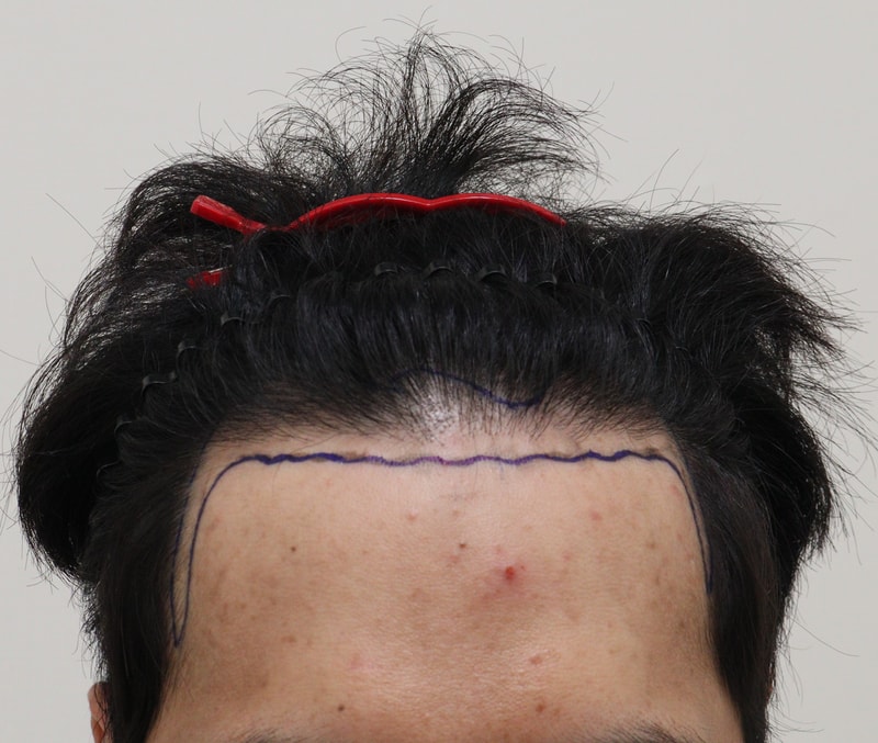 모발이식 재이식 6개월차 어떤가요