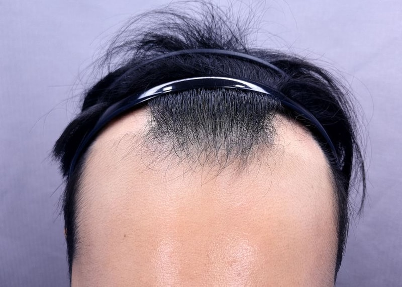 m자,정수리 탈모 득모했습니다