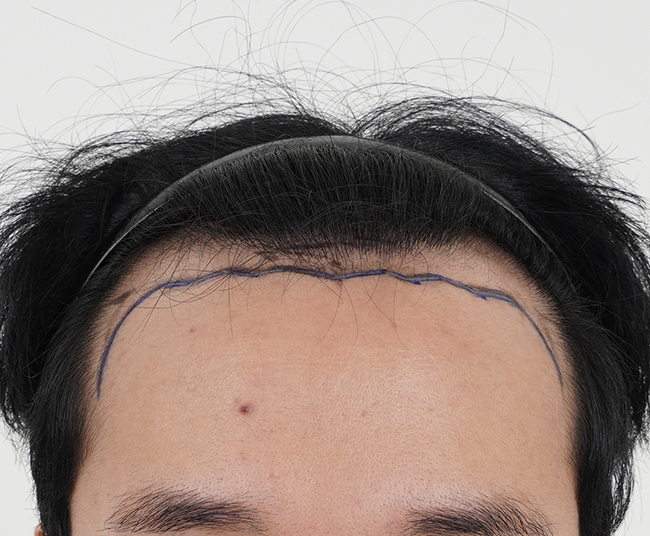 Anyang Talmo Hospital MOMO HAIR TRANSPLANT Suwon Branch incision 3,400 hair transplants were reviewed.