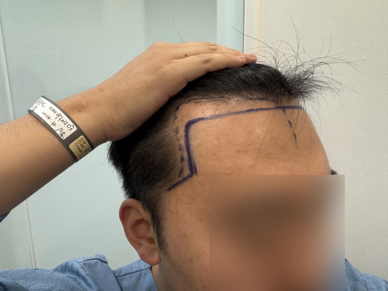 헤어라인 무삭발 비절개모발이식 1400모낭 1년!! 모원성형외과