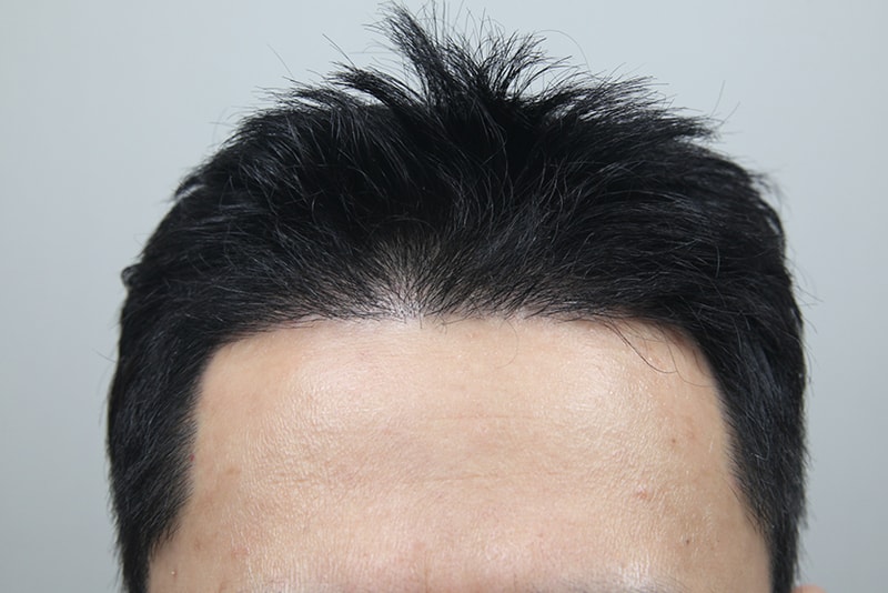 모나라모발이식 (1).jpg