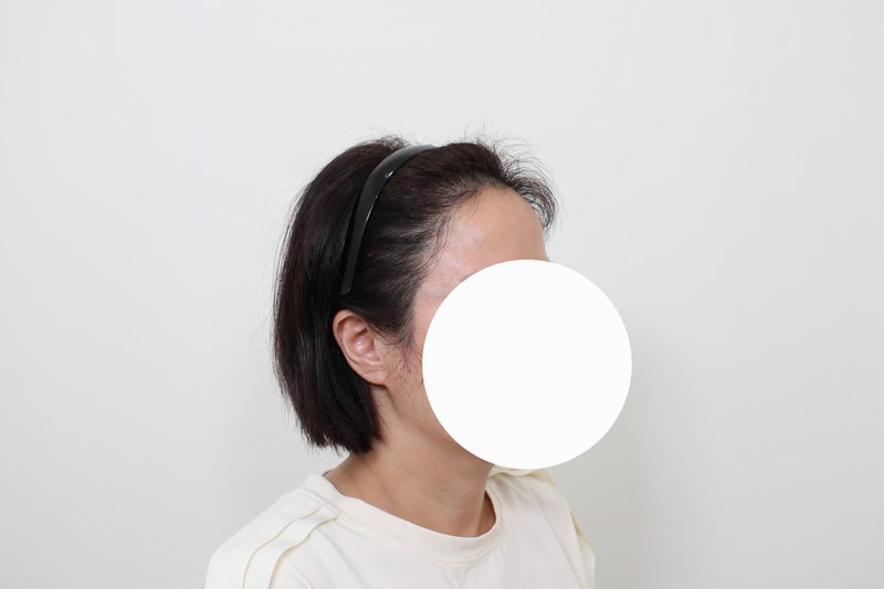 6 months of Hair Transplant review