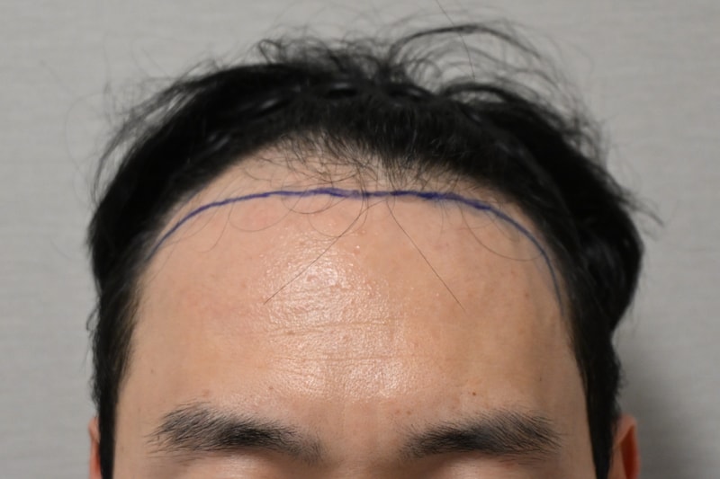 수술경과 6개월 후기 (모다올의원 홍준현 원장님)