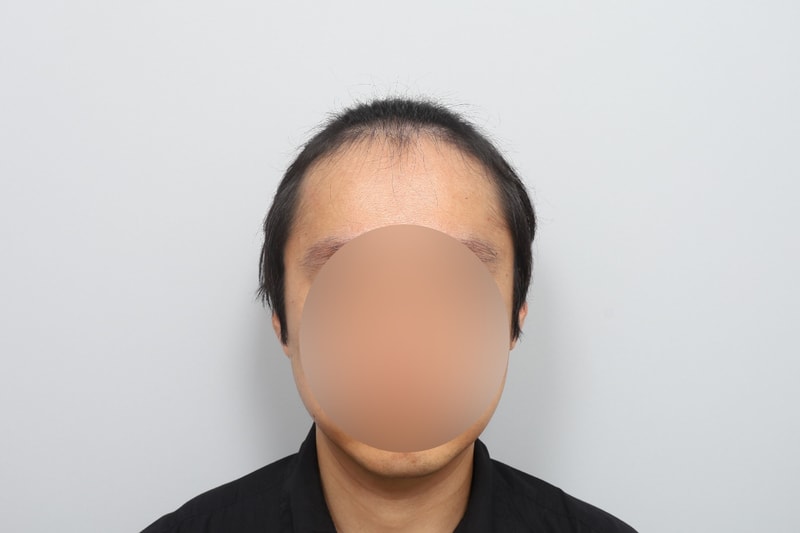 전두부 헤어라인 1900모낭 비절개 모발이식 5개월차 모원성형외과