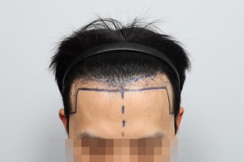 모원성형외과 1700모낭 (현미경 이식) 비절개 무삭발 이식 후기입니다. 감사합니다.