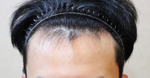JP Hair Transplant Clinic Hair Transplant 1st year review (non-intersected 3000mo)