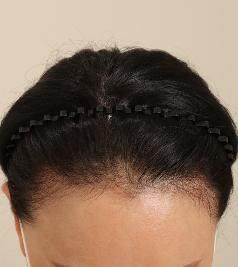 1. 수술전_2.JPG
