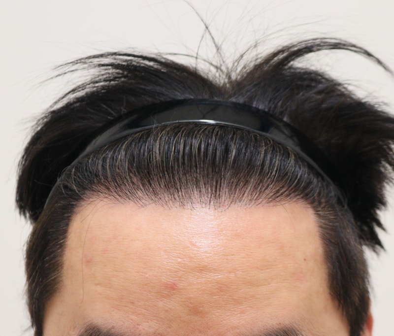 5. 수술후_1년_1.JPG