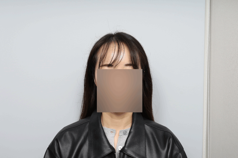 헤어라인 모발이식 1500모낭 모원성형외과 박종옥원장님