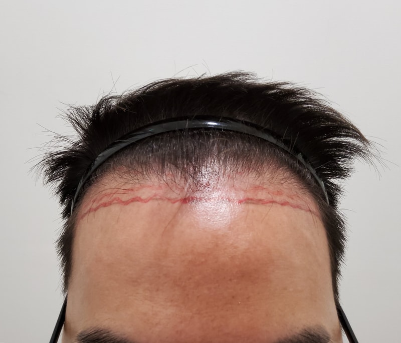 정수리 탈모초기.,,, 엠자탈모 .. 엠자만 이식했습니다