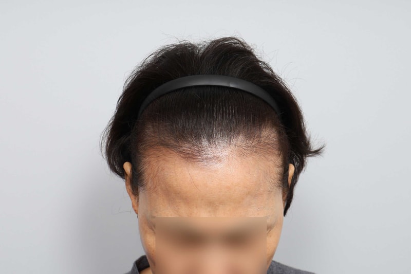 무삭발 비절개 헤어라인 1000모낭 수술 2주, 모발이식 모원성형외과